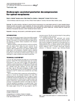 Endoscopic assisted posterior decompression for spinal neoplasms