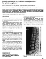 Endoscopic Decompression Spinal Metastasis