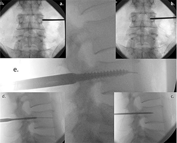 Intensifier Radiographs
