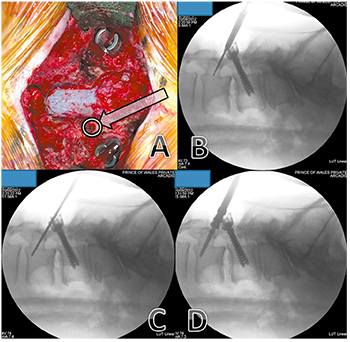 Posterolateral Fusion