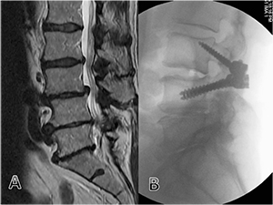 Spondylolisthesis