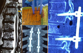 Technique, challenges and indications for percutaneous pedicle screw fixation
