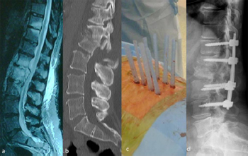 Technique, challenges and indications for percutaneous pedicle screw fixation