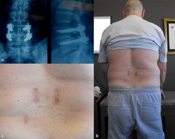 Technique, challenges and indications for percutaneous pedicle screw fixation