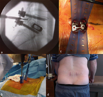 Technique, challenges and indications for percutaneous pedicle screw fixation
