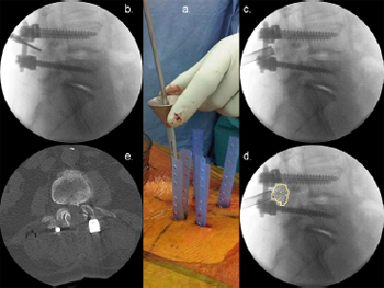 Technique, challenges and indications for percutaneous pedicle screw fixation