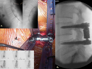Technique, challenges and indications for percutaneous pedicle screw fixation