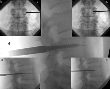 Technique, challenges and indications for percutaneous pedicle screw fixation
