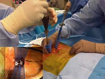 Technique, challenges and indications for percutaneous pedicle screw fixation