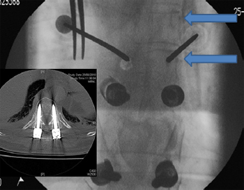 Technique, challenges and indications for percutaneous pedicle screw fixation