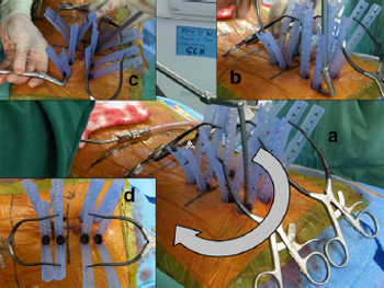 Technique, challenges and indications for percutaneous pedicle screw fixation