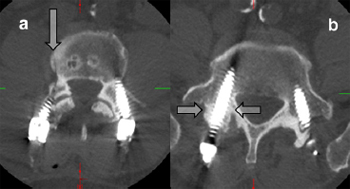 Technique, challenges and indications for percutaneous pedicle screw fixation
